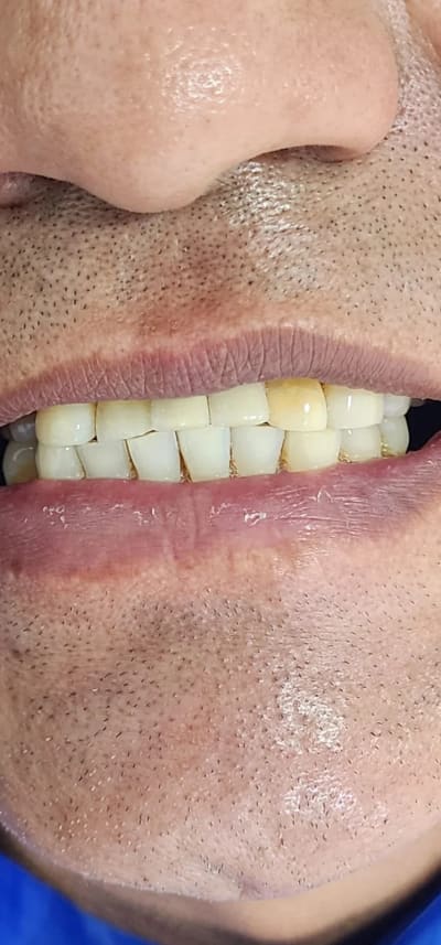Después: Implantes dentales