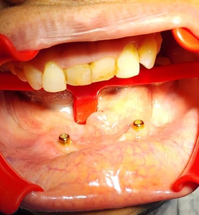 Antes: Prótesis sobre implantes