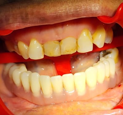 Después: Prótesis sobre implantes