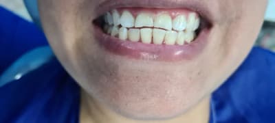 Antes: Carillas de resina piezas 8 y 9