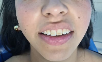 Antes: Carillas de resina piezas 8 y 9