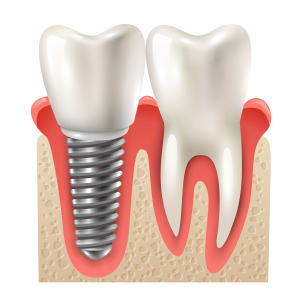Dental implant treatment at BR Dental Hospital, Ghorahi, Dang