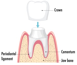 Dental Crowns BR Dental Hospital Ghorahi Dang