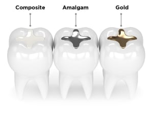 Cavity Fillings and Restoration BR Dental Hospital Ghorahi Dang