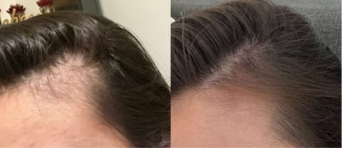 Hairline regrowth before and after 9 months