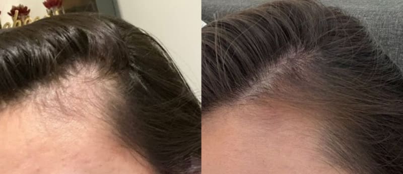Before and after comparison showing hairline improvement over 9 months of consistent scalp-focused care