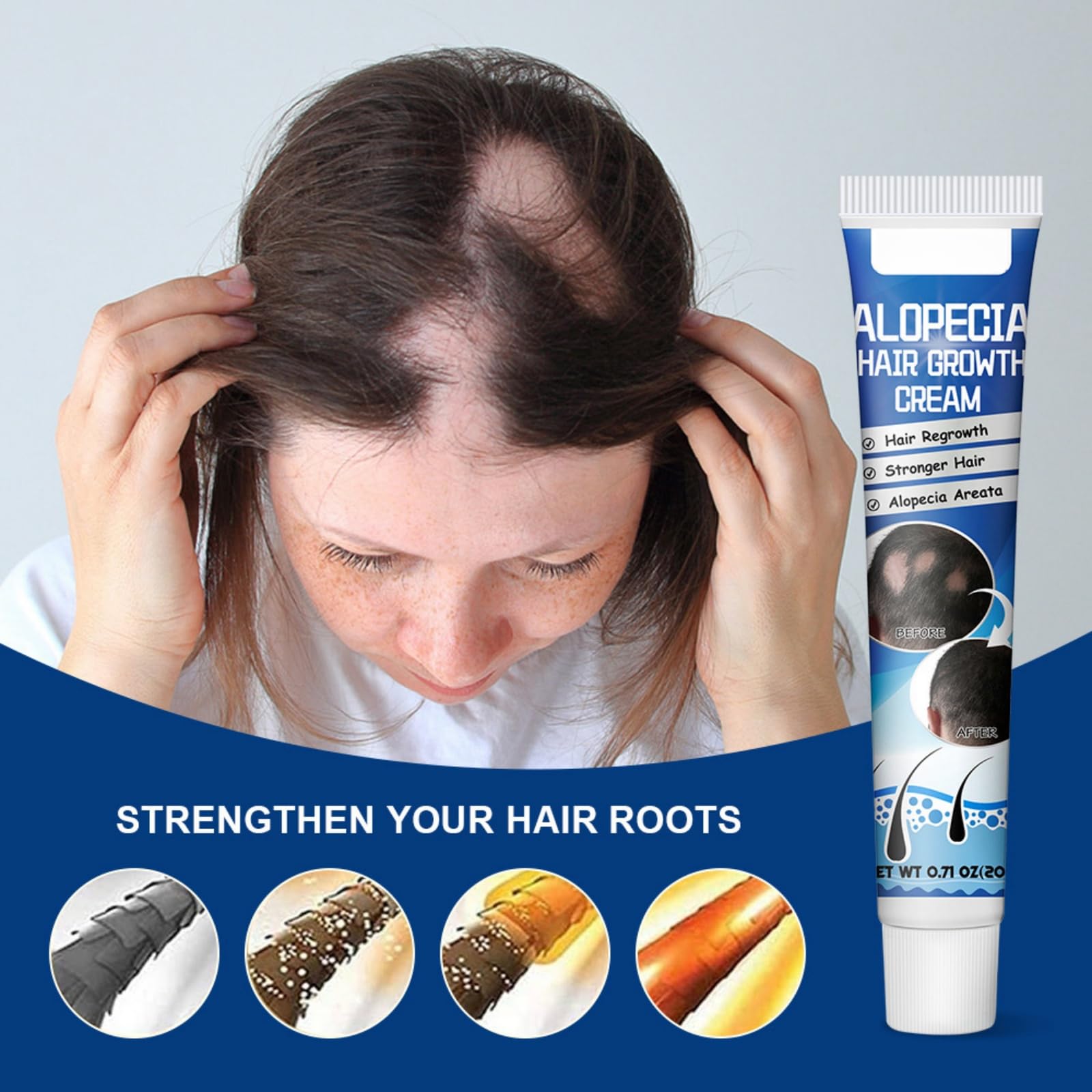 Alopecia