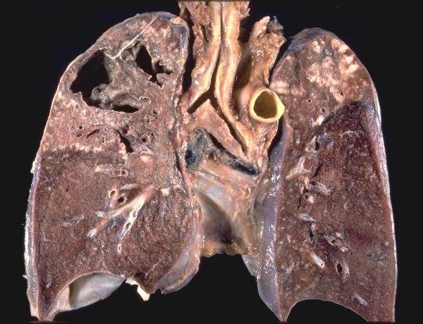 Bacillinum Burnett: A Nosode for Respiratory Weakness