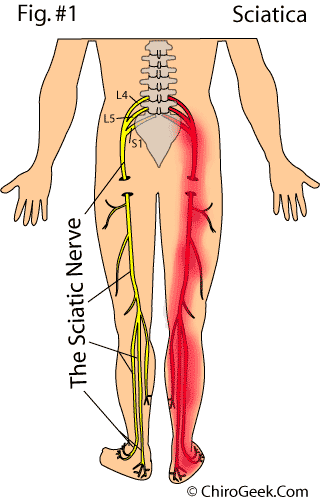 SCIATICA
