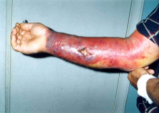 ANTHRACINUM-NOSODE