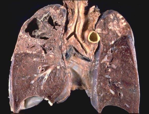 BACILLINUM BURNETT-NOSODE