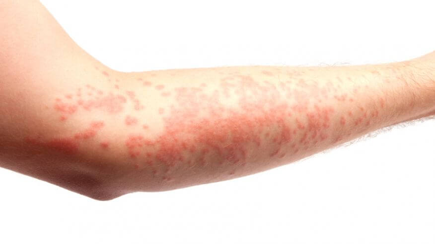 REMEDIES FOR ECZEMA
