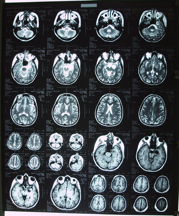 Brain Tumor- Casestudy 2 -