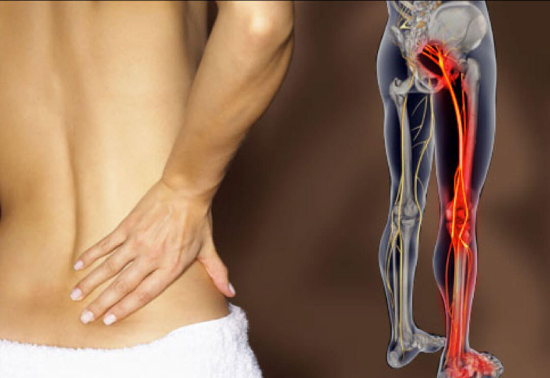 REMEDIES FOR SCIATICA
