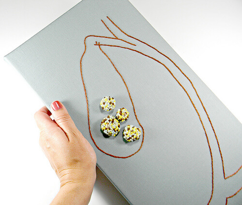 gallstones gallstones