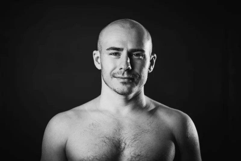 Strange Cures For Baldness Around the World