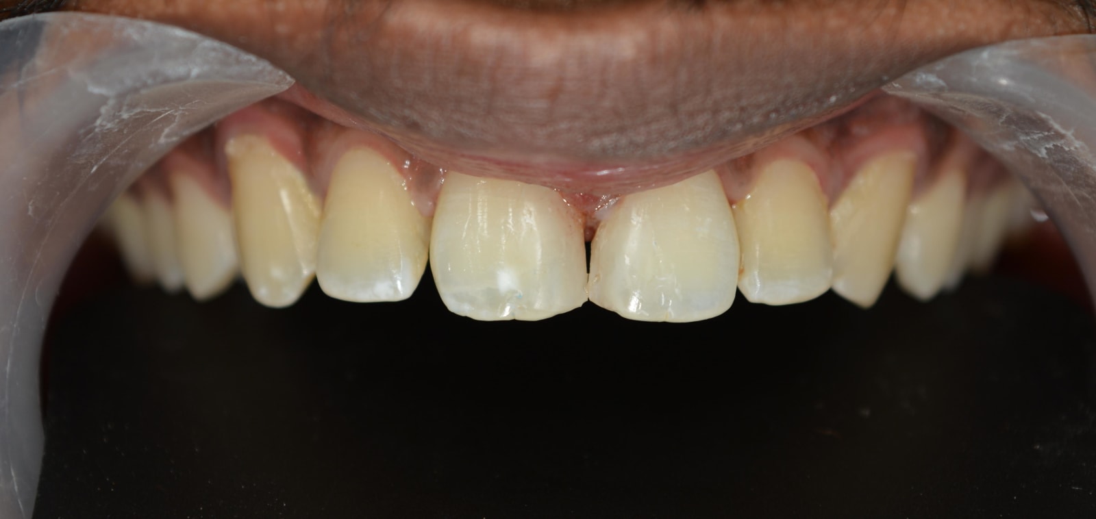 After Treatment — Clinical Photos