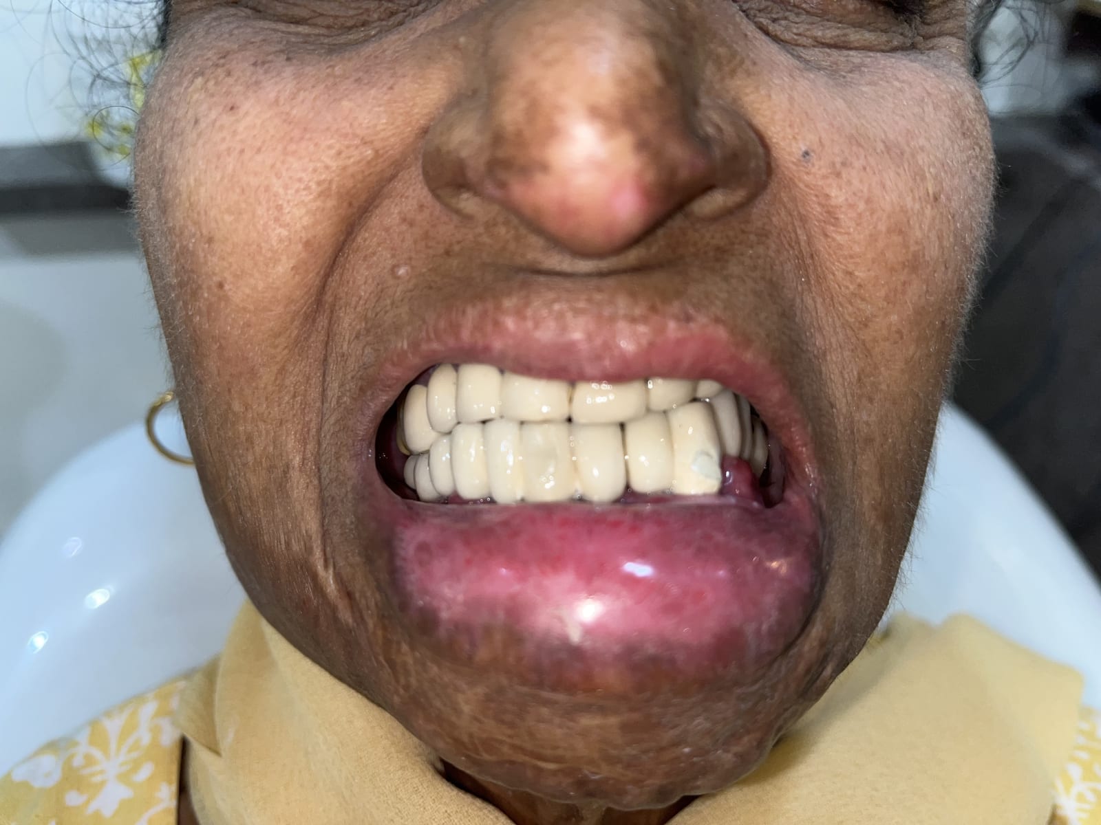 After Treatment — Clinical Photos