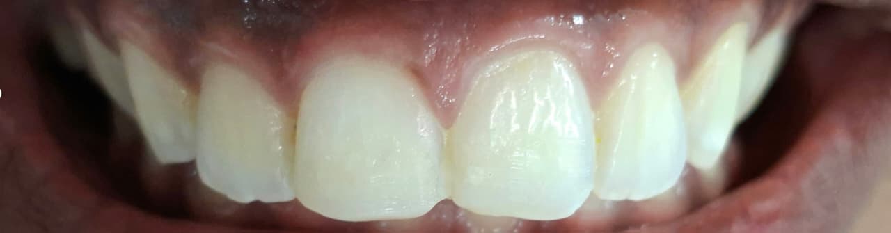 After Treatment — Clinical Photos