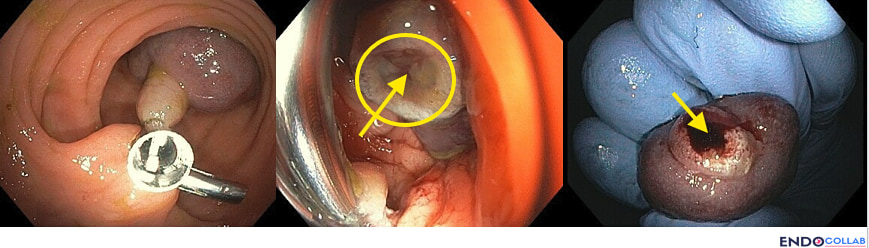 Three-panel endoscopic composite showing the technique sequence: prophylactic hemoclip on the polyp stalk before resection; the post-resection stump with the clipped pedicle highlighted by a yellow circle; and a close-up of the resected specimen pedicle revealing a large feeding vessel marked with yellow arrows.