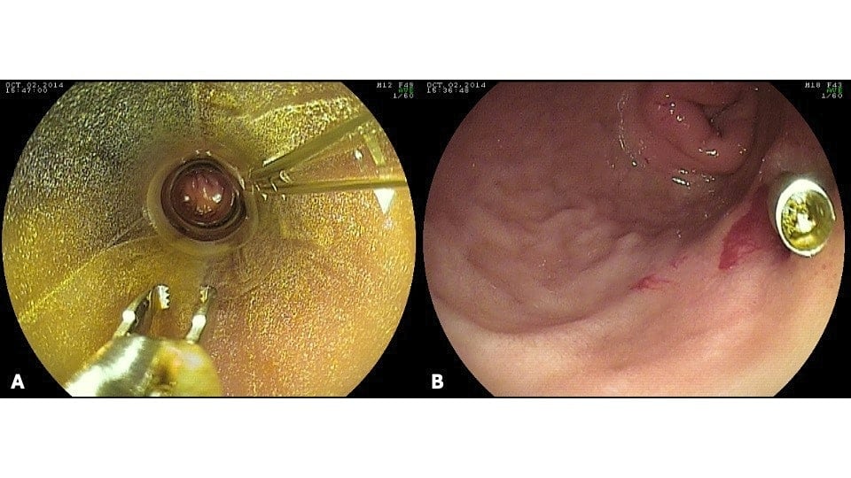Clinical endoscopic image