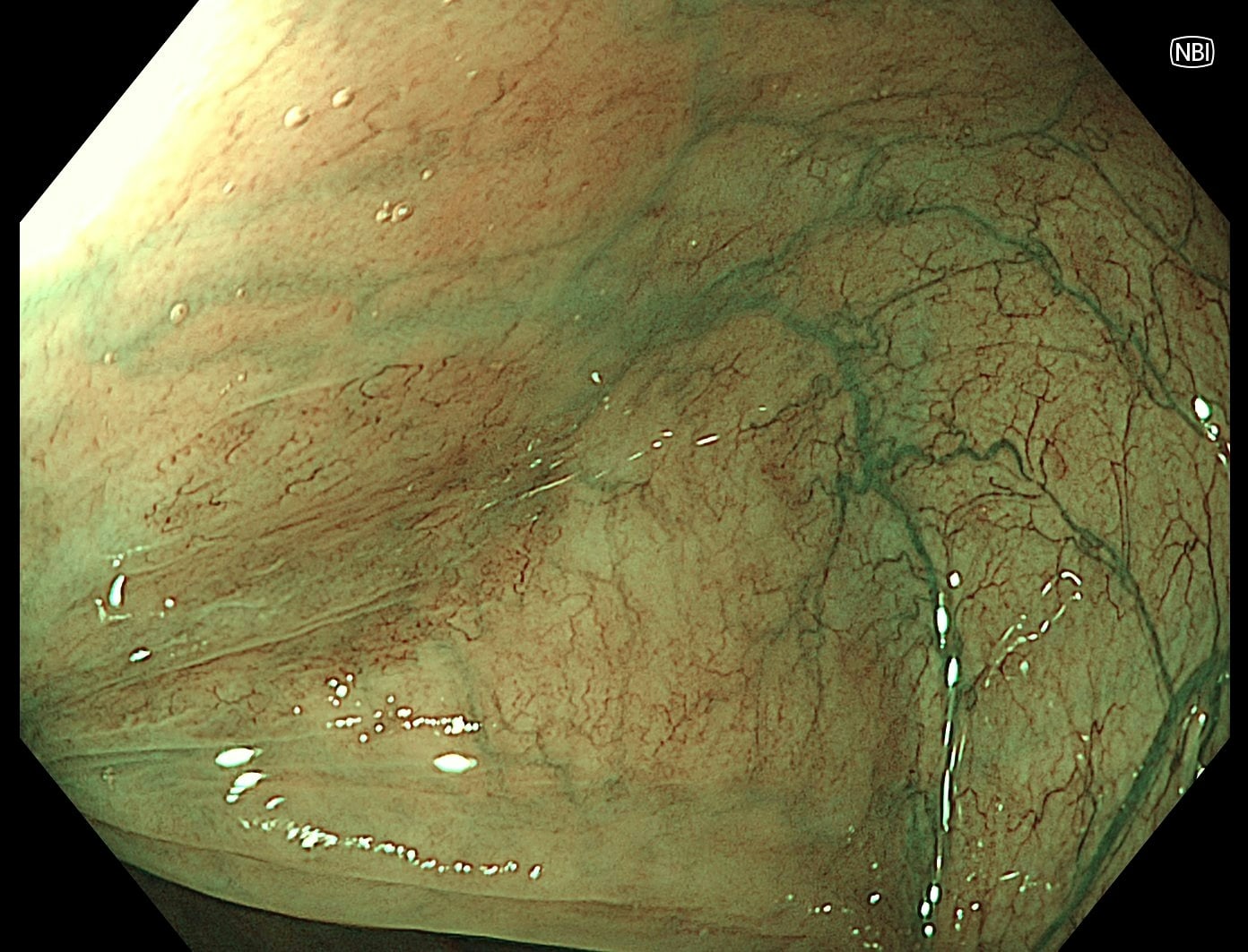 Clinical endoscopic image