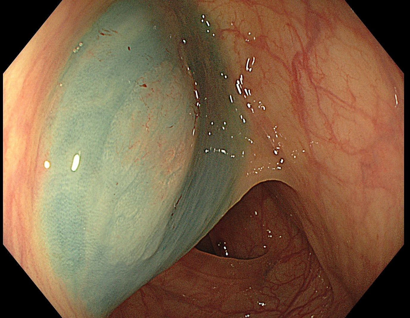 Clinical endoscopic image