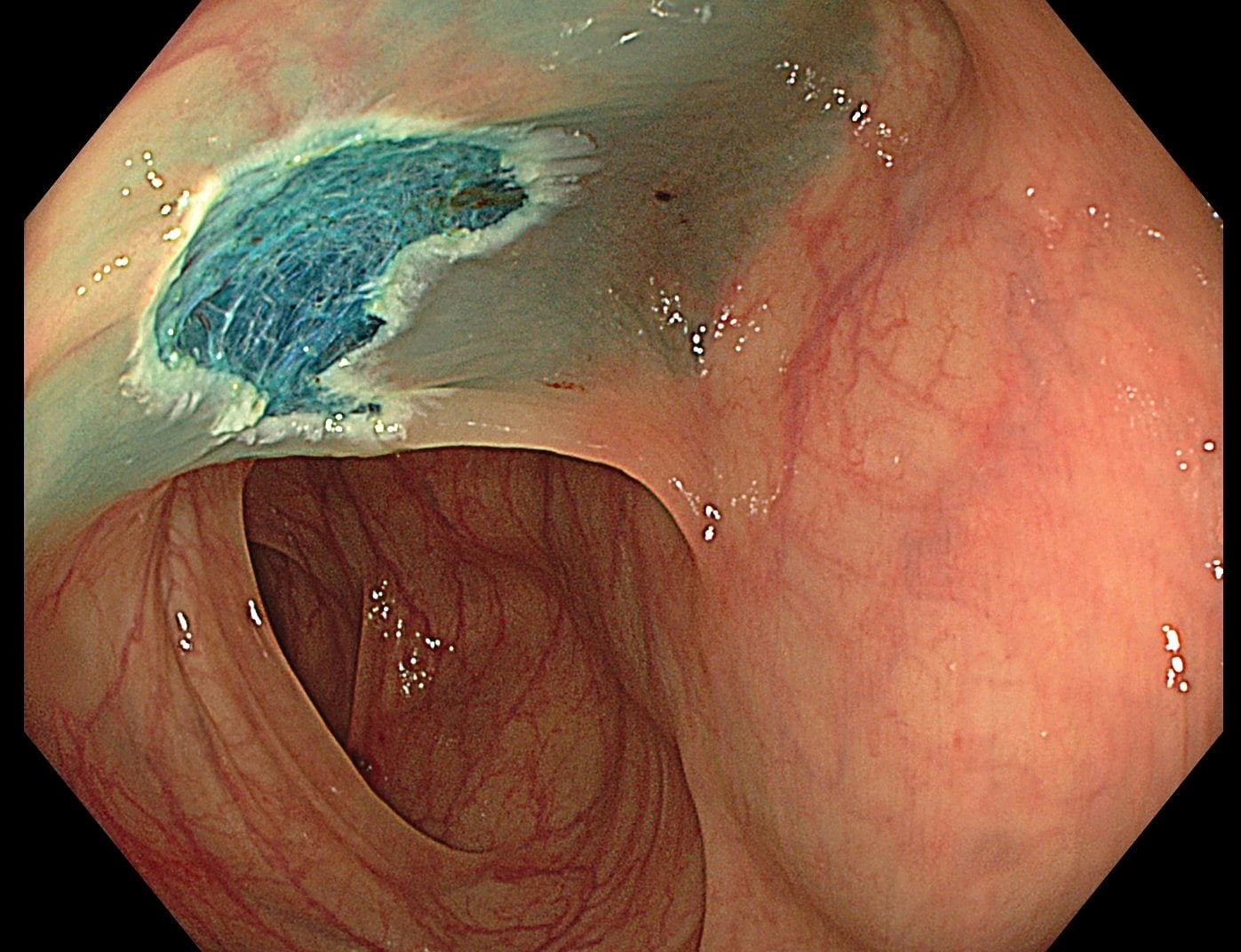 Clinical endoscopic image