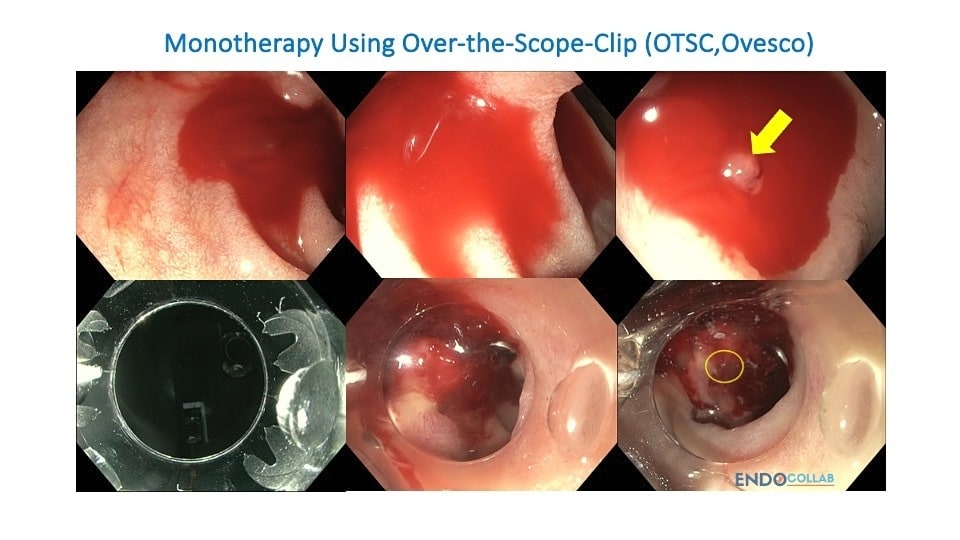 Clinical endoscopic image
