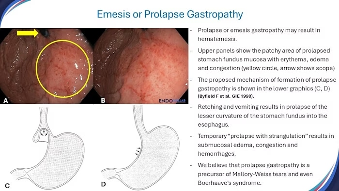 Clinical endoscopic image