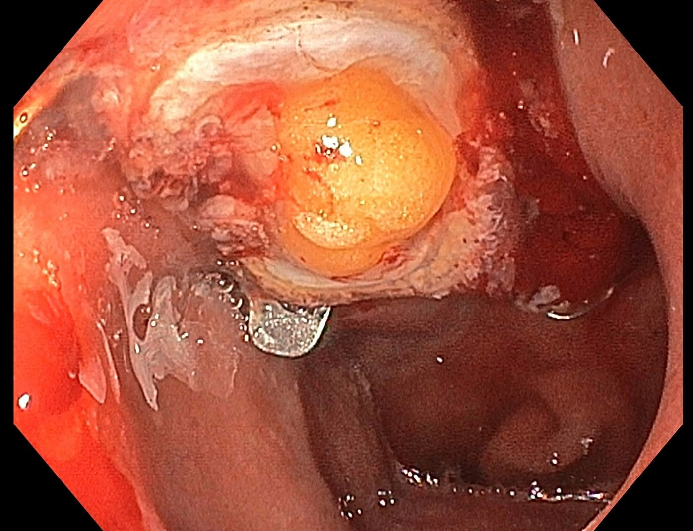 Clinical endoscopic image