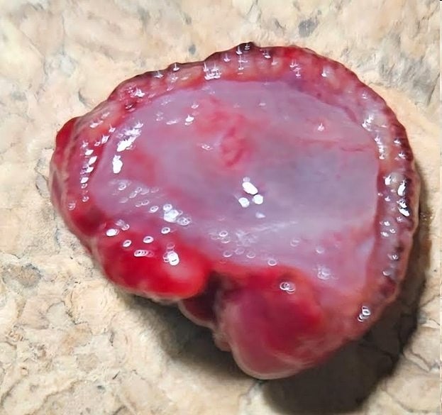 Clinical endoscopic image