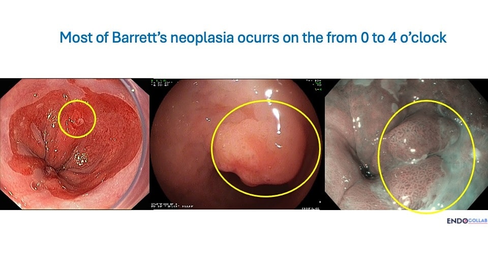 Clinical endoscopic image