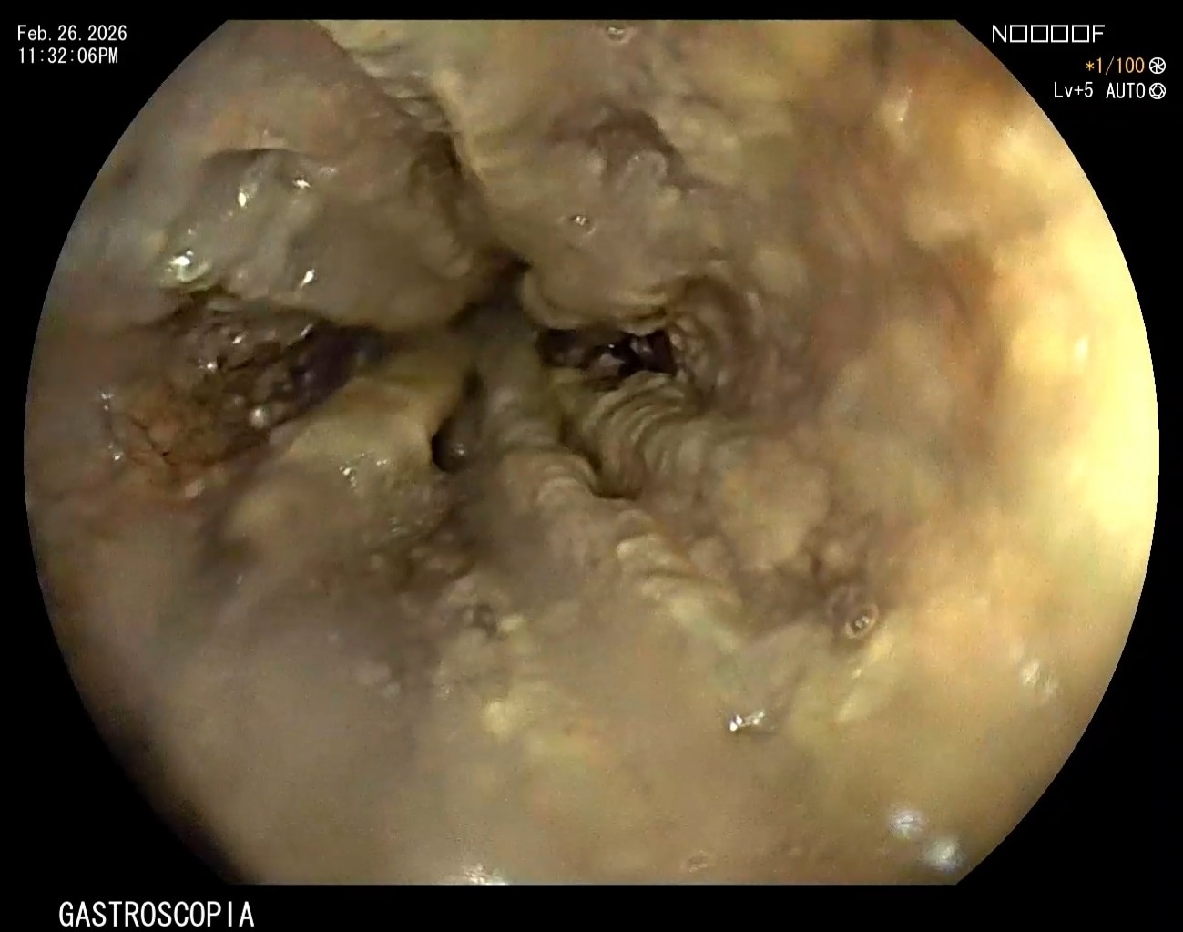 Clinical endoscopic image