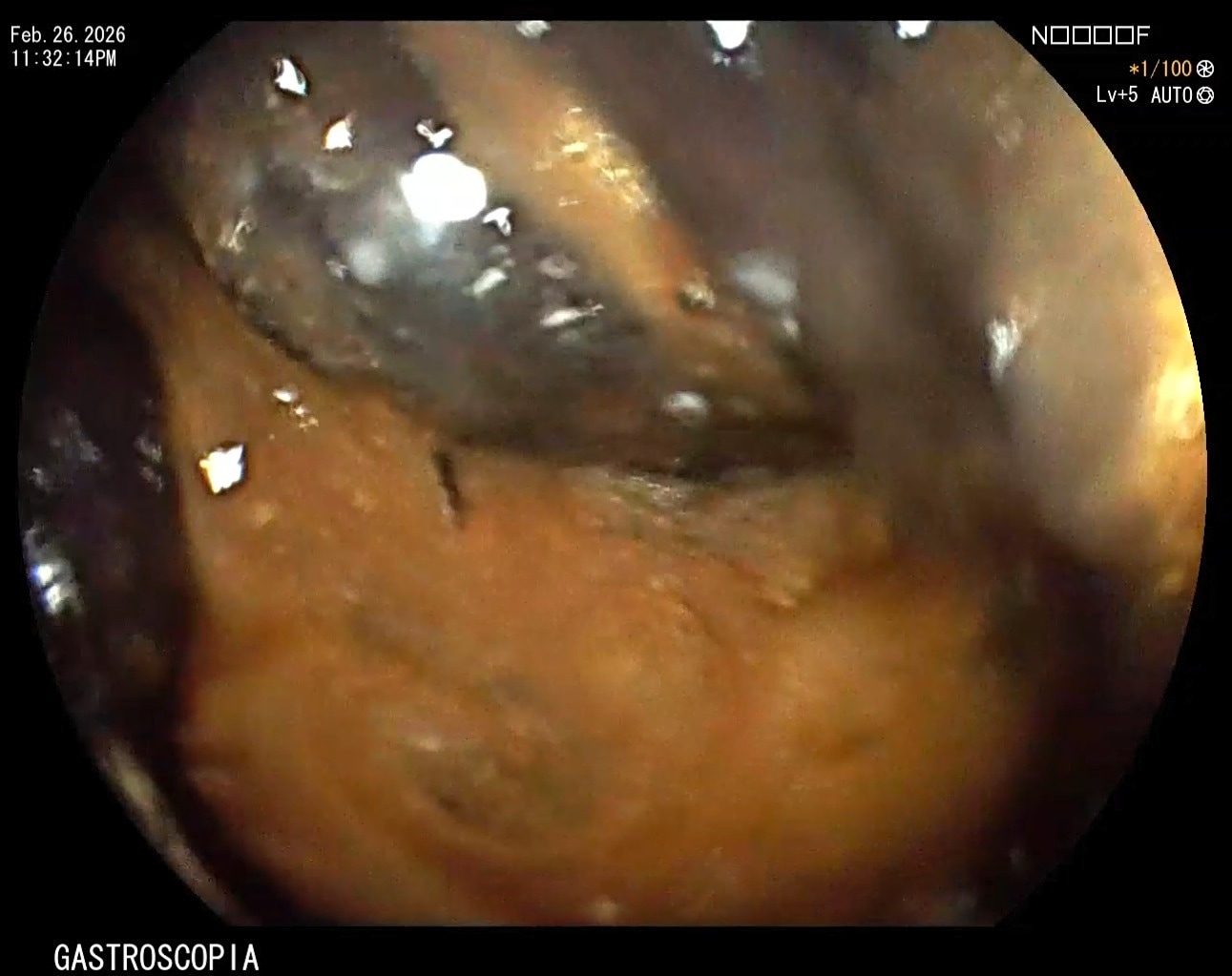 Clinical endoscopic image