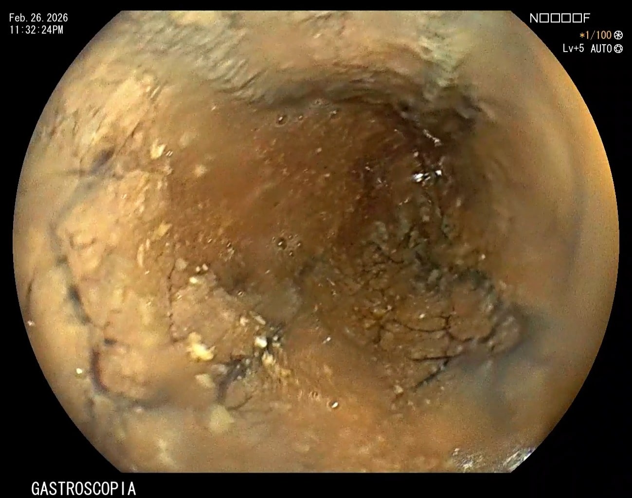 Clinical endoscopic image