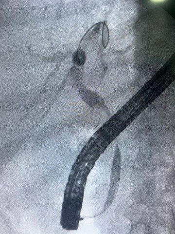 Figure 1. ERCP cholangiogram.&nbsp;Extrinsic narrowing and deformation of the main bile duct, compatible with pseudo-Mirizzi syndrome.
