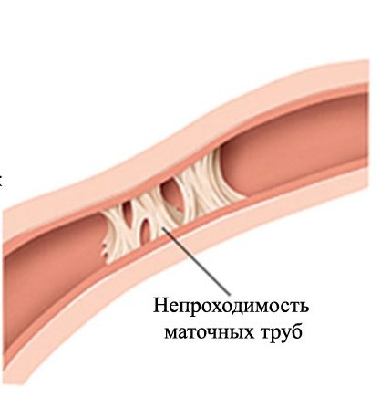 Спайки у женщины причины. Непроходимость маточных труб. Непроходимость фаллопиевых труб. Закупорка маточных труб. Трубно-перитонеальное бесплодие.