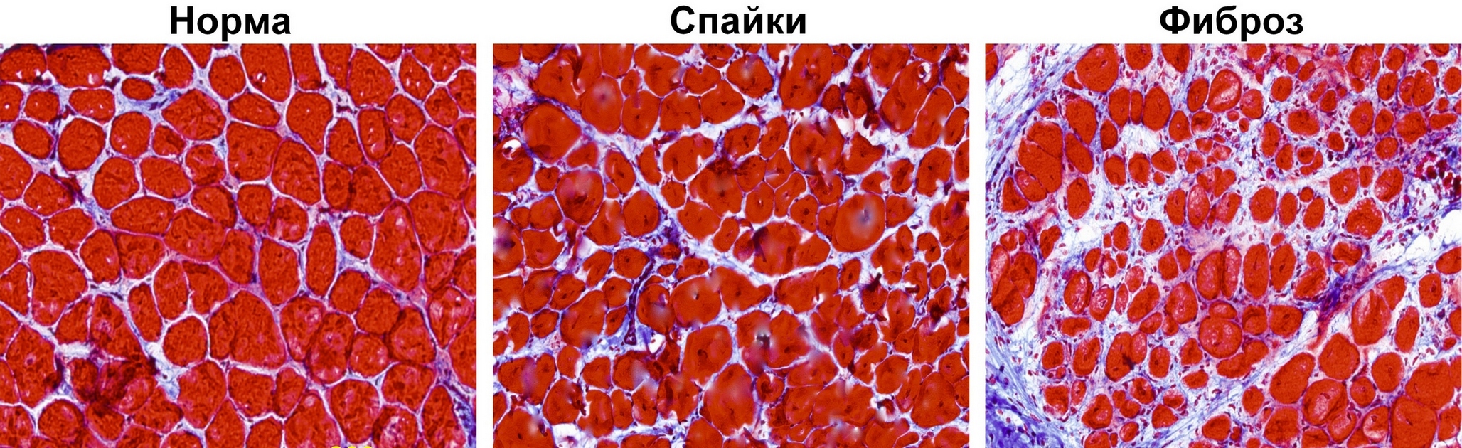 Фиброзные изменения тканей. Фиброз мышечной ткани спины. Фиброз соединительной ткани.