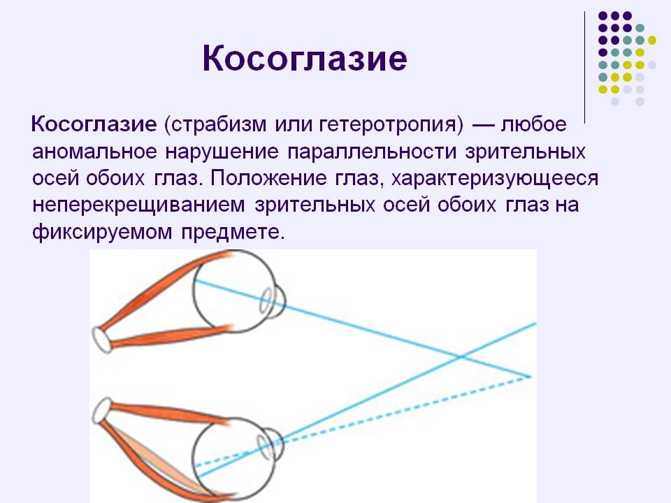 Презентация на тему косоглазие