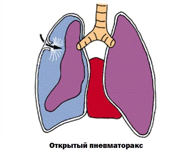 Карта смп пневмоторакс спонтанный