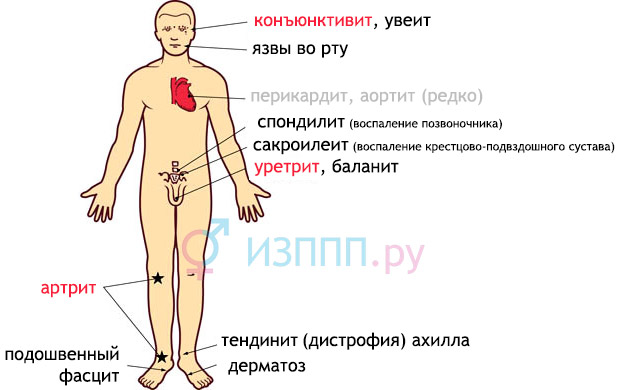 Клиническая картина синдром рейтера