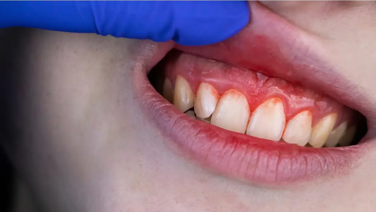 How to Treat Gingivitis at Home