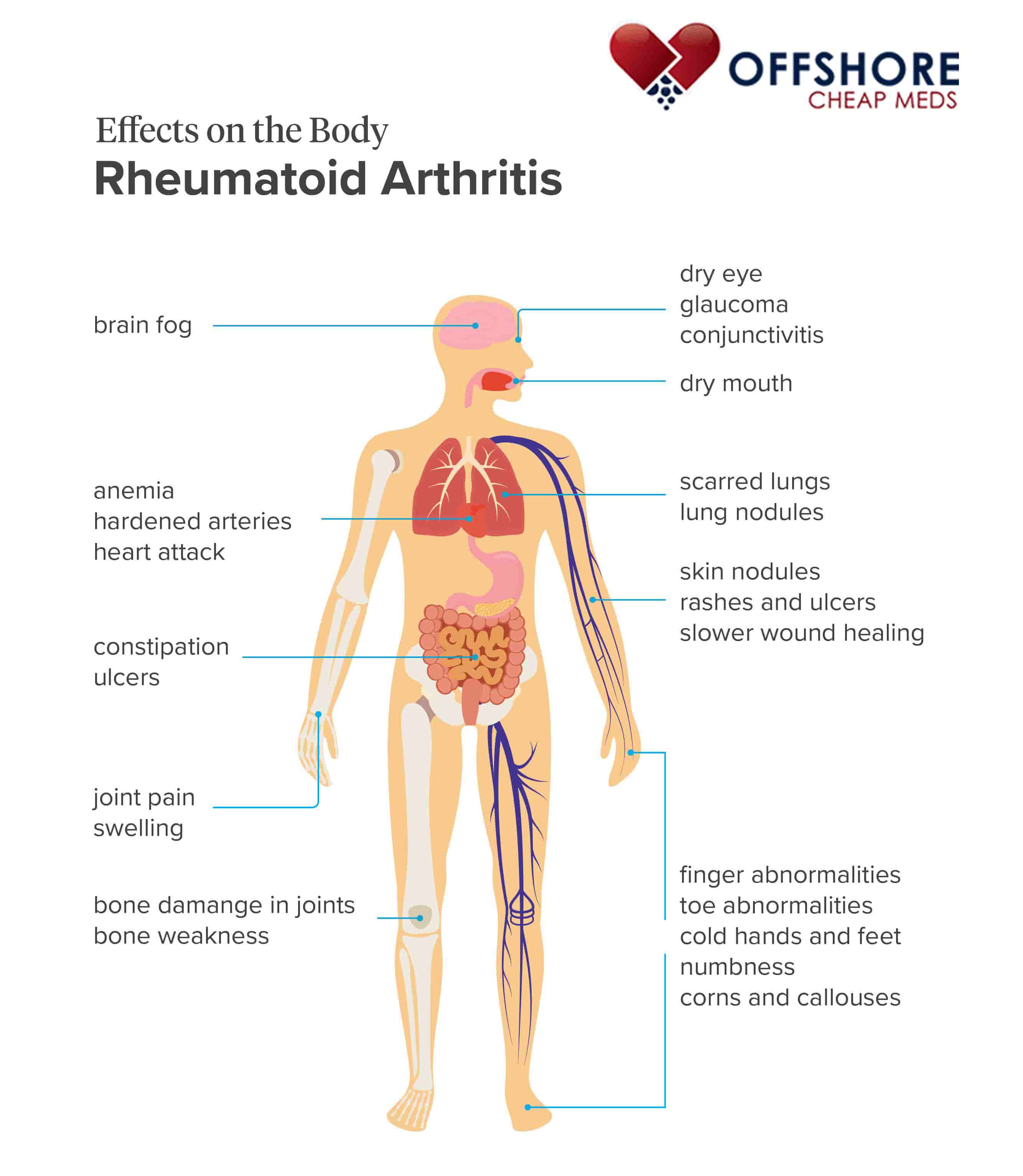 What Are The Complications Of Rheumatoid Arthritis 1 Best Online   Effects On The Body Of Rheumatoid Arthritis Infographic OffshoreCheapMeds.com Mkqlfl 