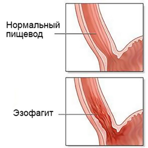 Катаральний езофагіт Катаральний езофагіт
