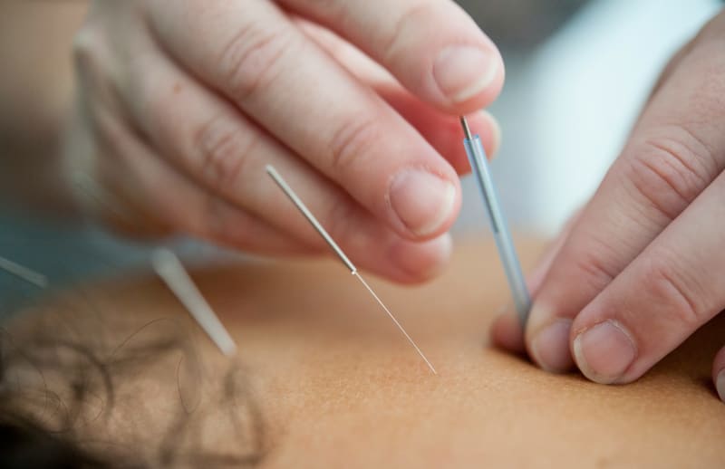 Dry needling treatment being applied for shoulder pain management