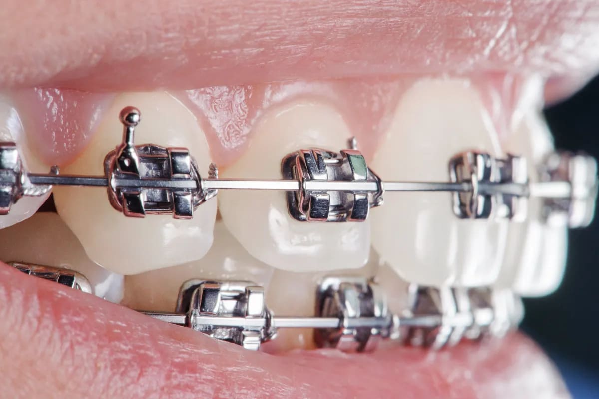Braces or Clear Aligners: Which is Right for You in the 75023 Area?, Plano, TX A person smiling with clear aligners