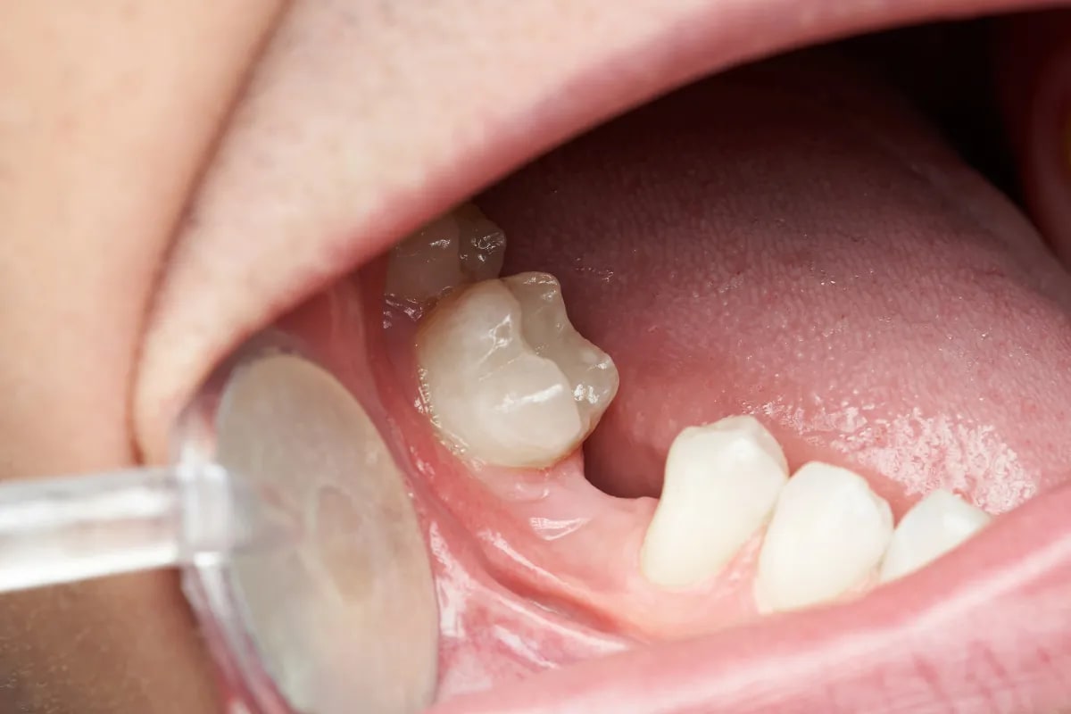 The Benefits of Dental Bridges for Missing Teeth near Legacy West, Plano, TX Dental bridge consultation