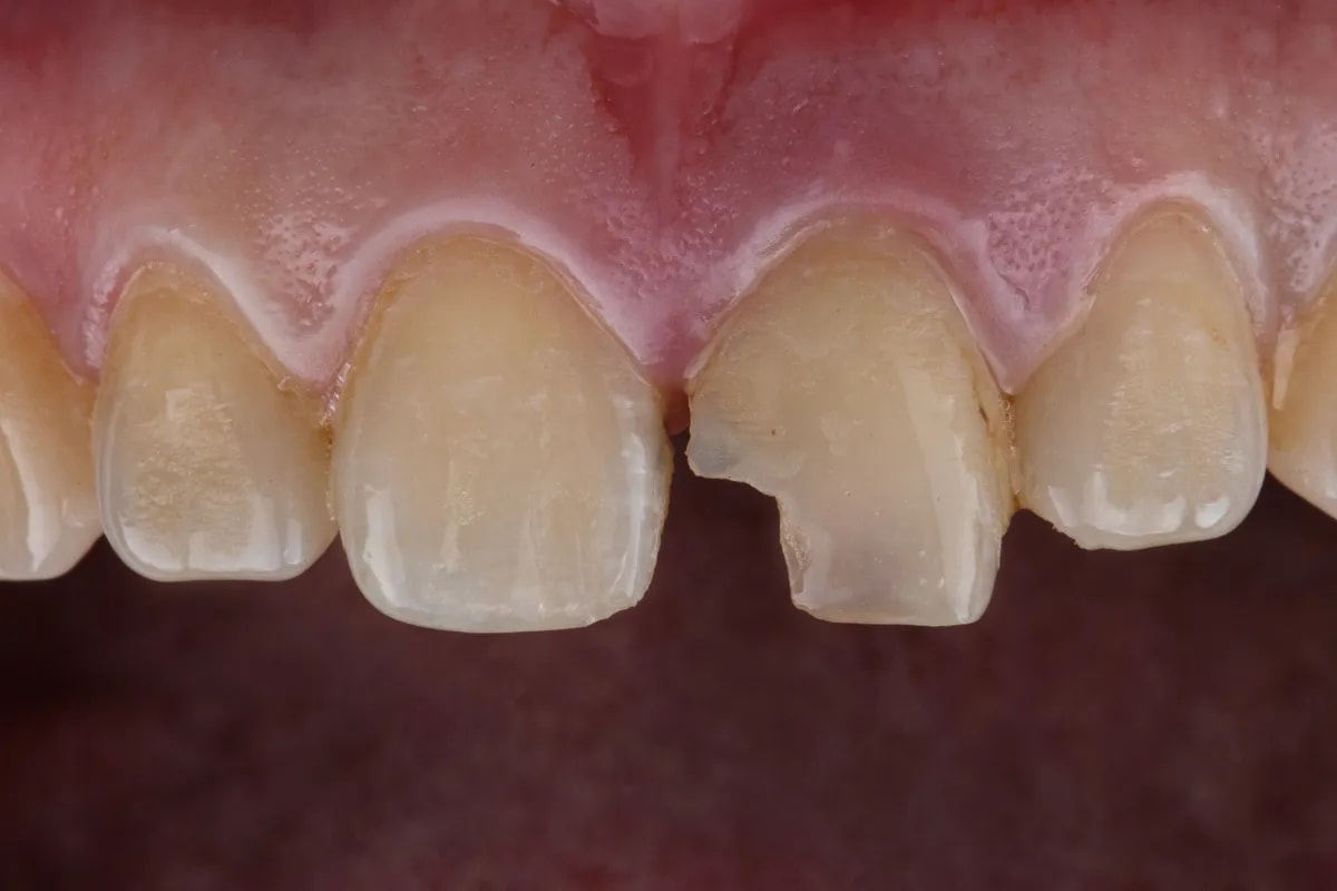 Chipped Tooth Repair in Plano: What to Do and Where to Go, Plano, TX Treatment Options for Chipped Tooth