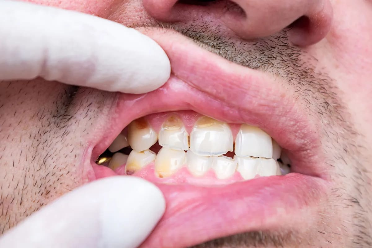 Chipped Tooth Repair in Plano: What to Do and Where to Go, Plano, TX Steps to take after chipping a tooth